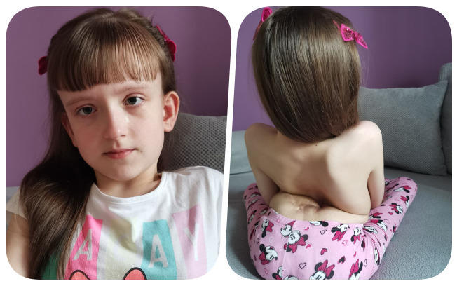 Ogromny dramat Zuzi. Tylko koszmarnie droga operacja kręgosłupa może ją uratować!-1